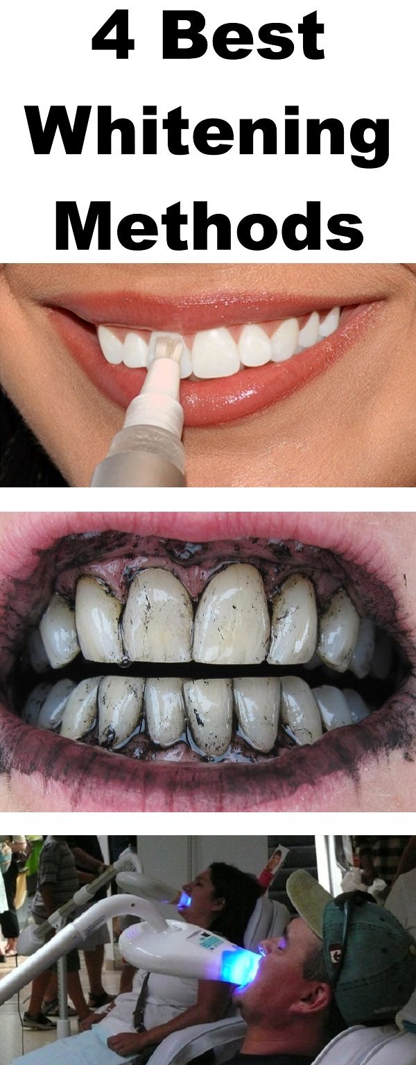 The 5 Best Teeth Whitening Methods for You?