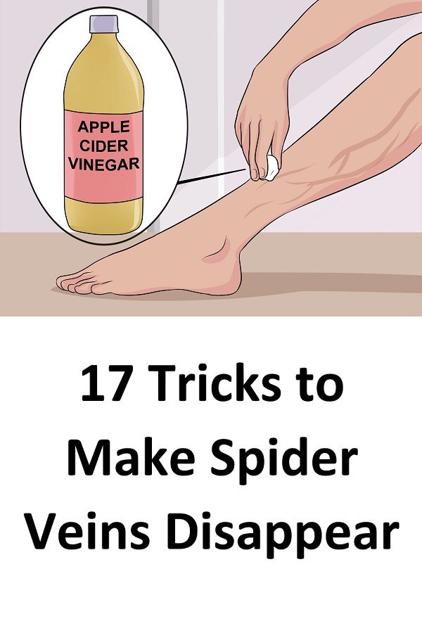 10 Ways To Get Rid Of Spider Veins On Your Legs Naturally